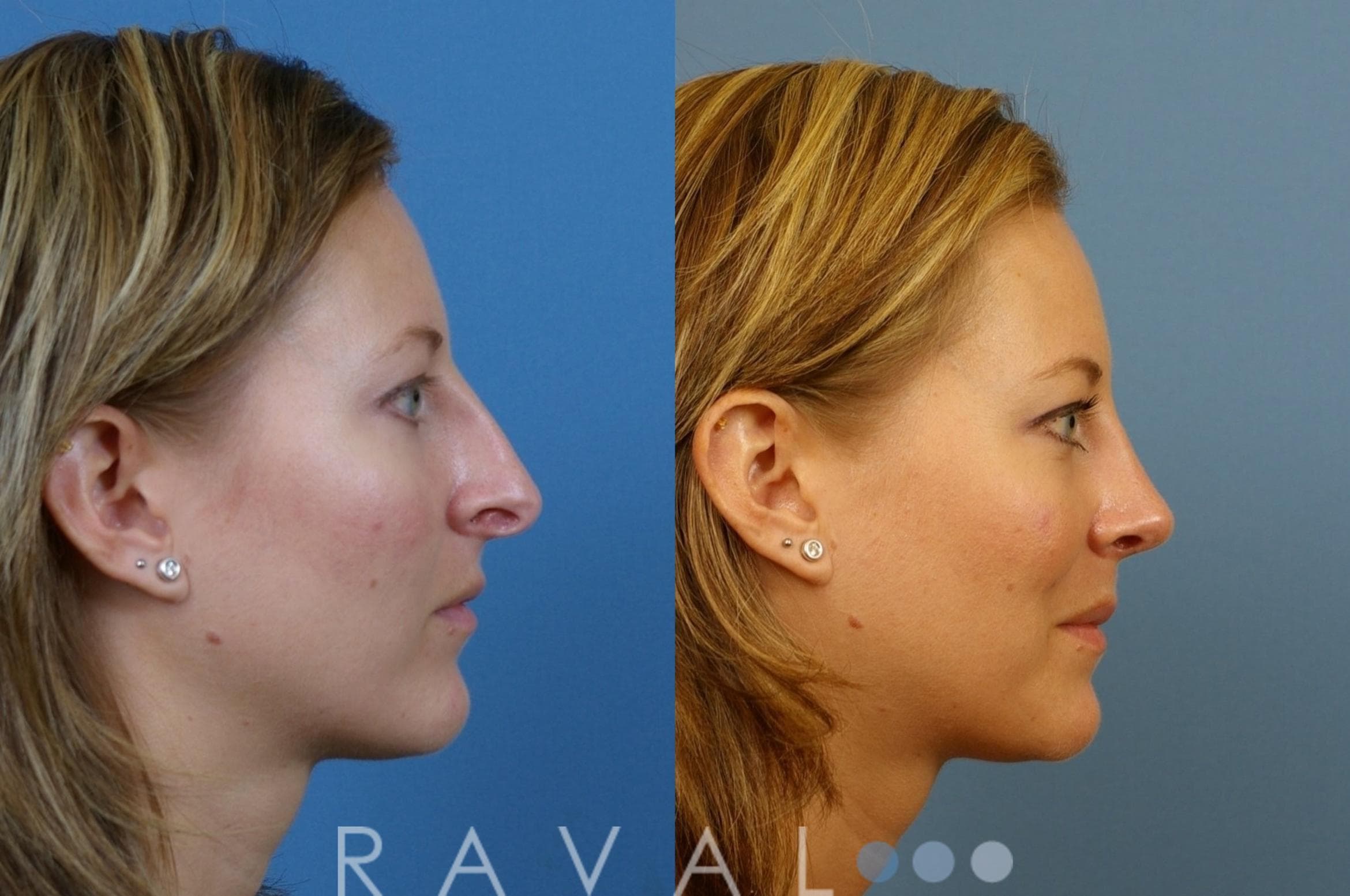 Before and After Rhinoplasty
