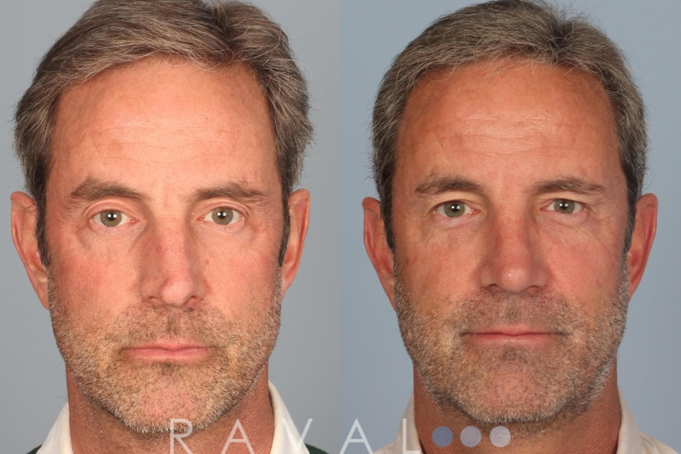 Before and After Rhinoplasty