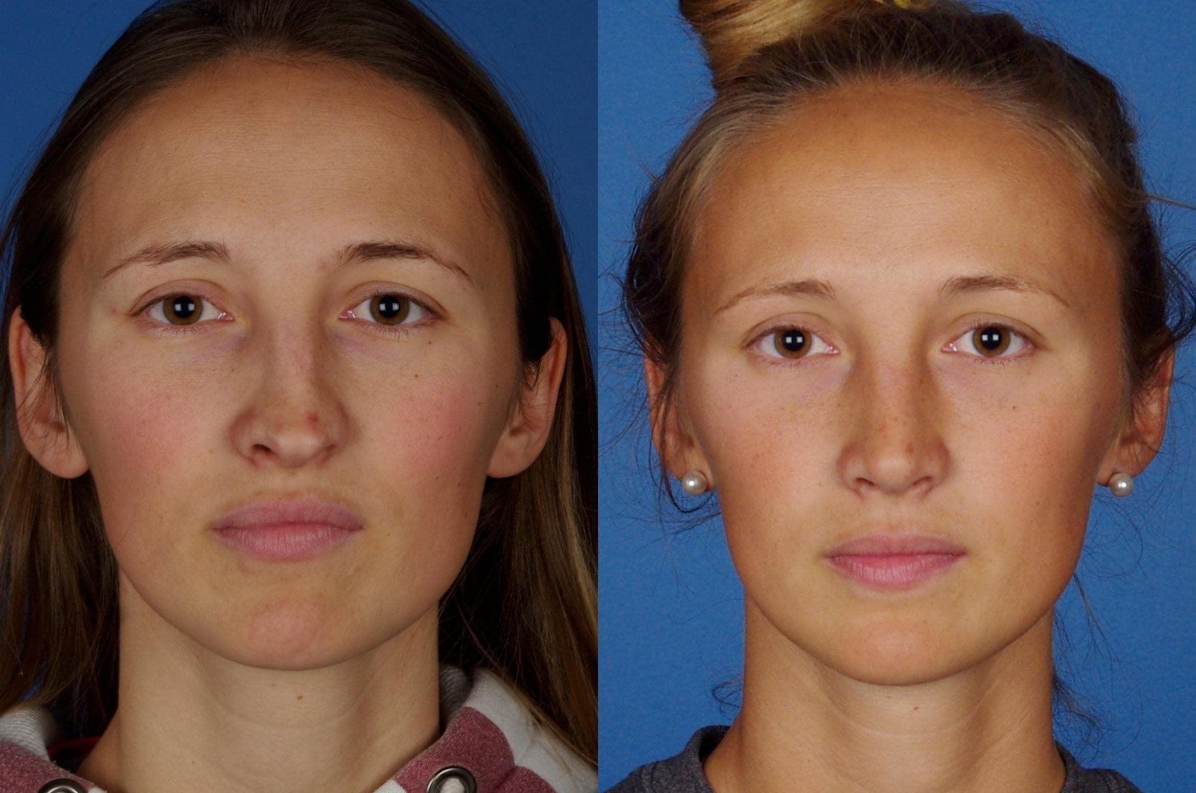Before and After Rhinoplasty