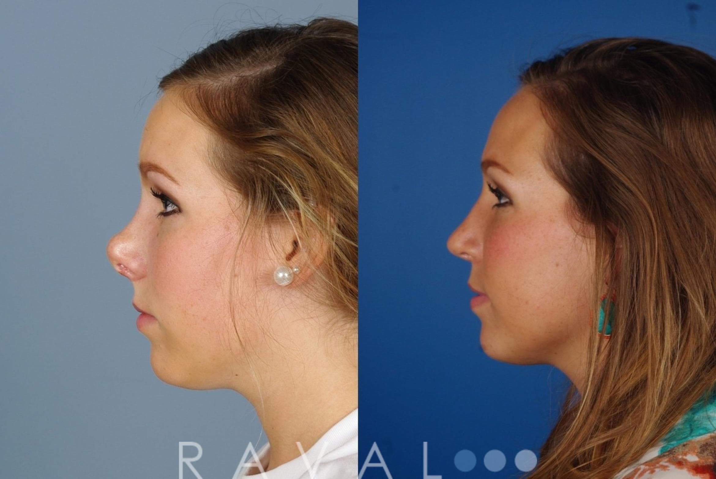 Before and After Face & Neck Lift