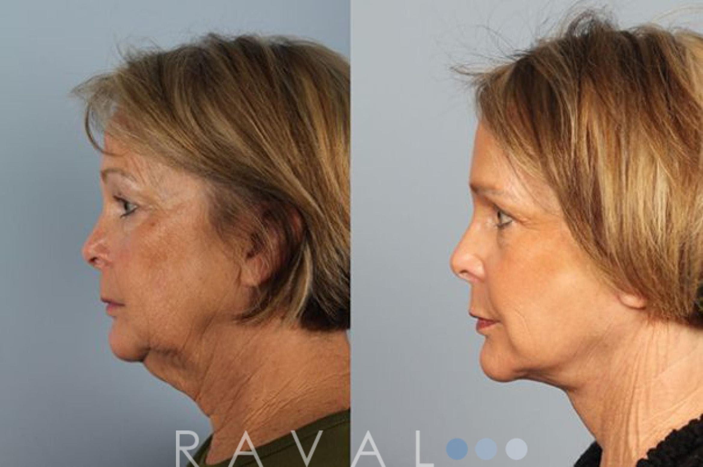 Before and After Face Lift