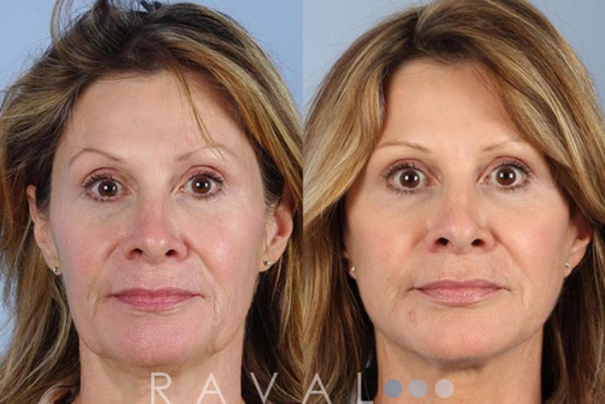 Before and After BOTOX