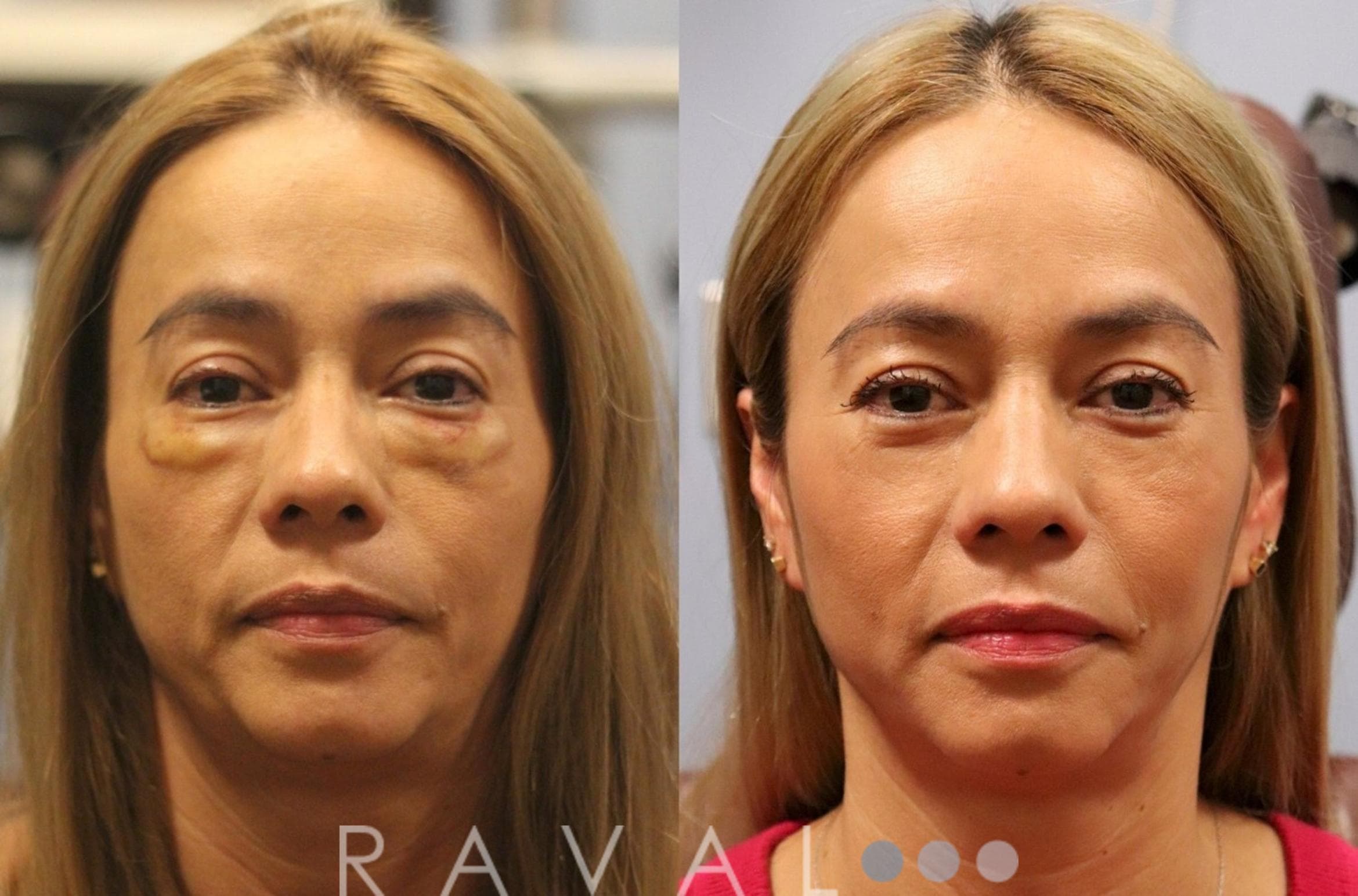Before and After BOTOX