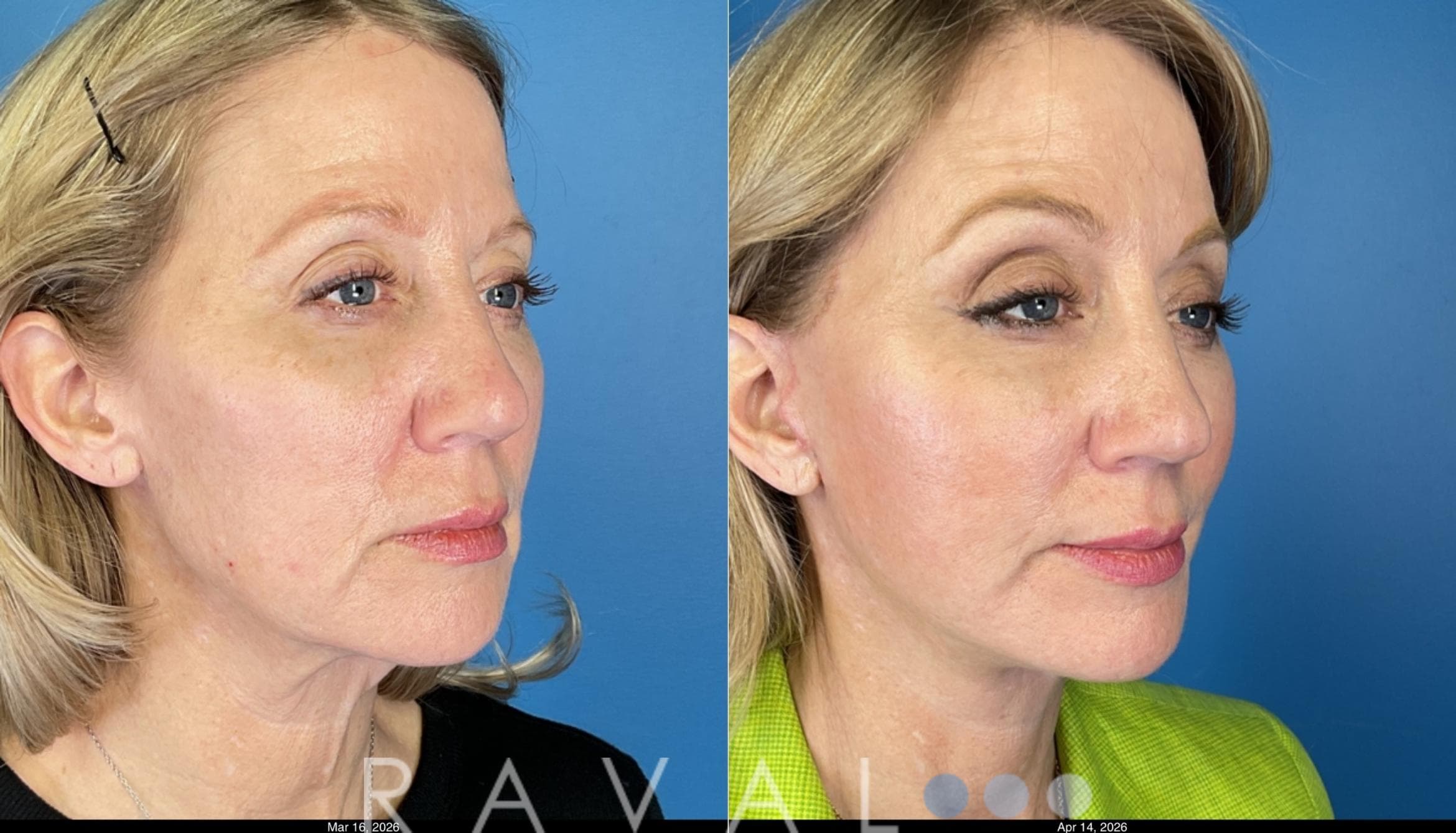 Before and After Face Lift