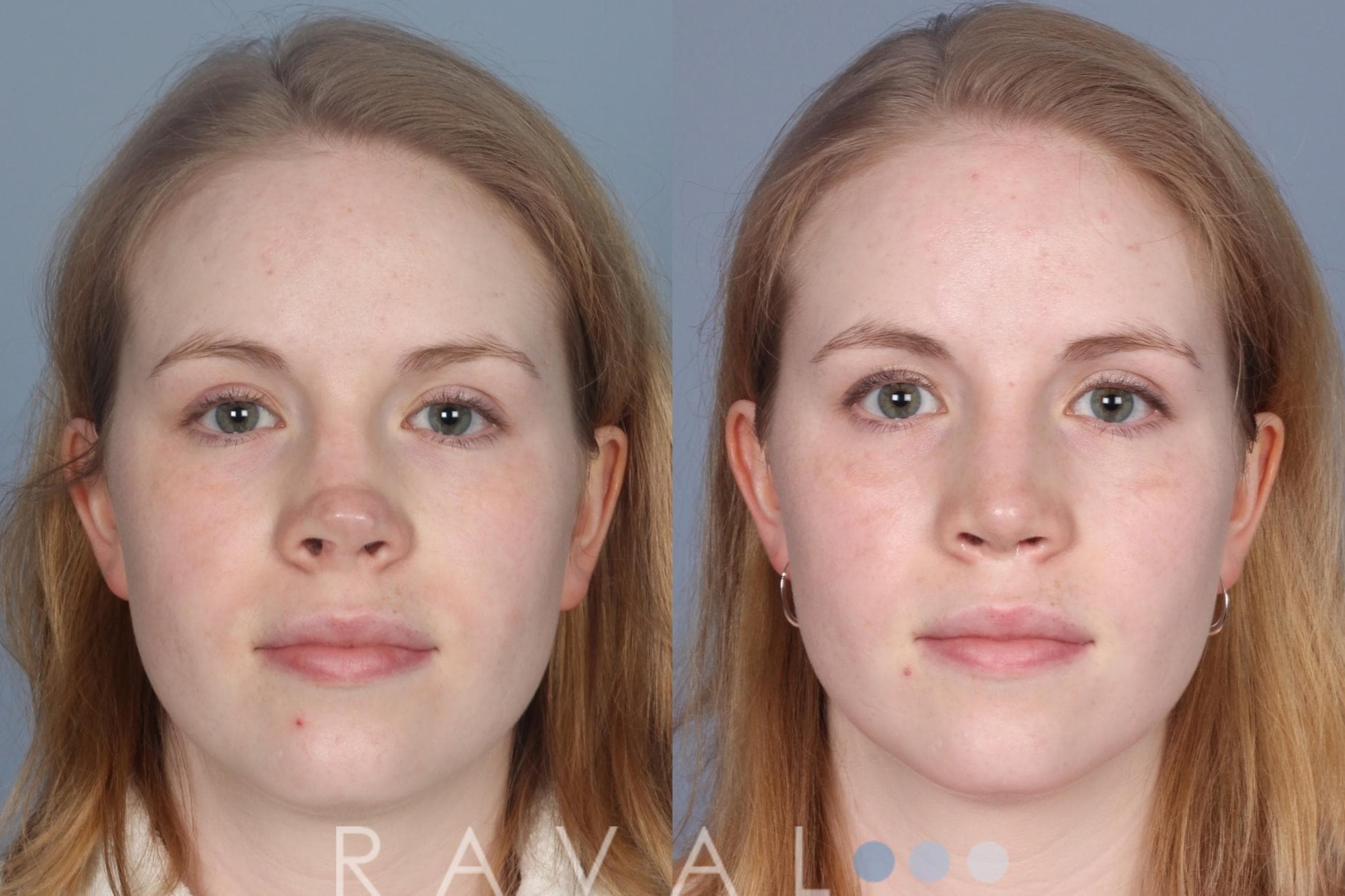 Before and After Revision Rhinoplasty