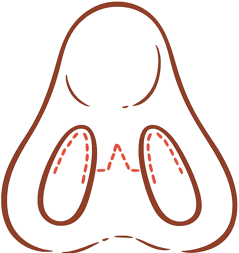 Open Rhinoplasty graphic