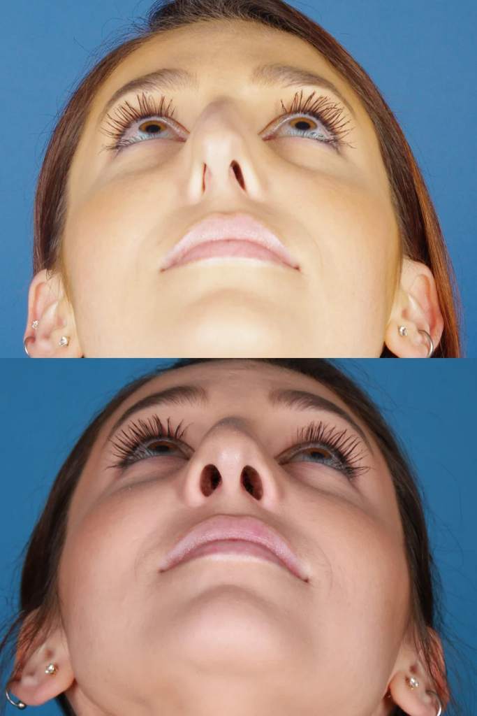 After Your Nasal Valve Repair Surgery