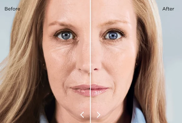 Sculptra Before and After