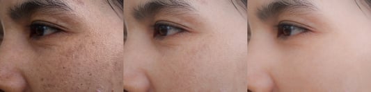 Acne Scars