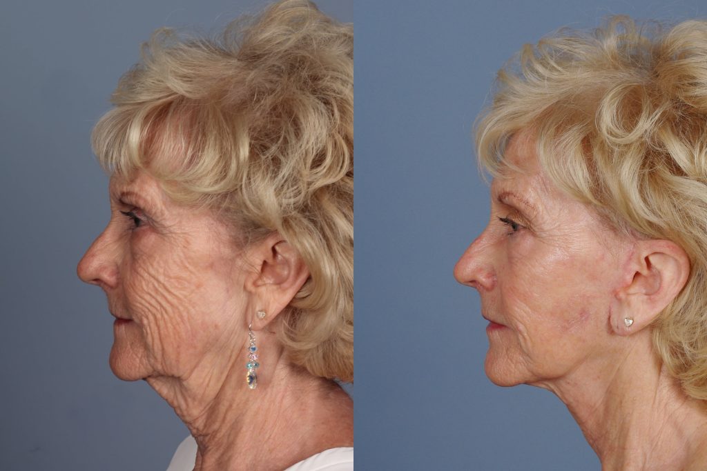 Before and After Facelift