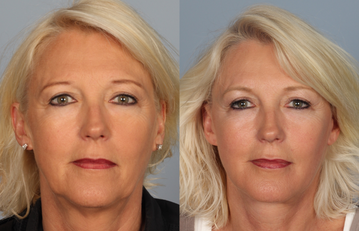 Before and After Facelift