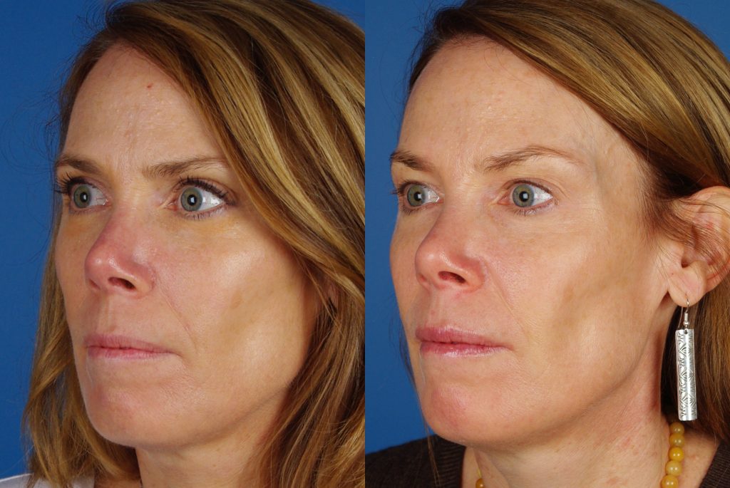 Microneedling before and after