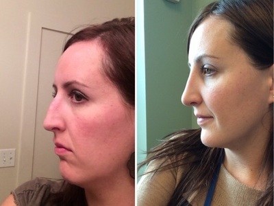 Before and After