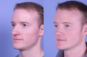 Unexpected Benefits of Rhinoplasty