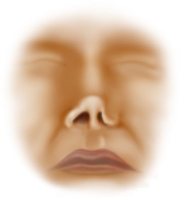 Nasal Valve Collapse Symptoms to Look For