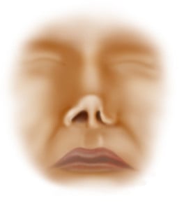 Nasal Valve Collapse