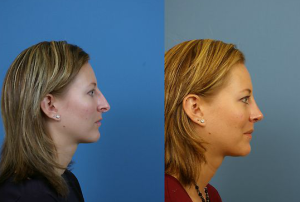 Having a Perfect Nose has Never Been Easier