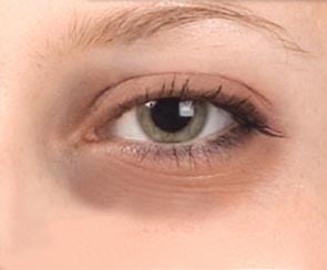 Restylane Under Eyes? Oh, Yes!