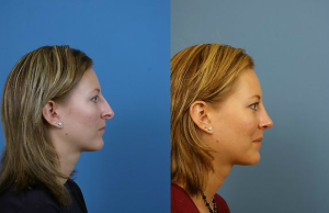 Rhinoplasty: Steps to Do Beforehand
