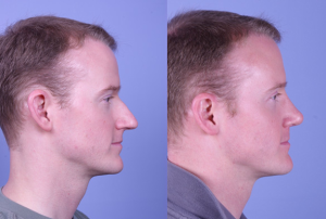 Benefits Of Having Rhinoplasty