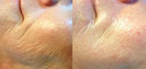 Denver Microneedling