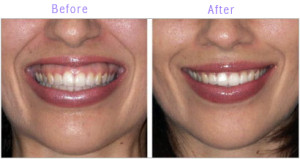 Alternatives for Botox