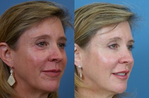 Botox Cosmetic Treatments Lead to More Youthful Skin