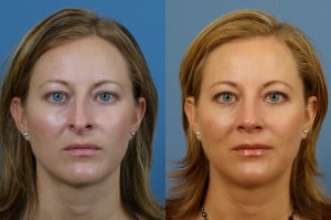 What to Ask During Your Rhinoplasty Consultation