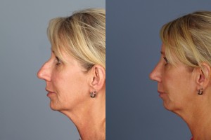 rhinoplasty risks