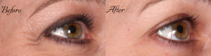 How Do Botox and Dysport Work?