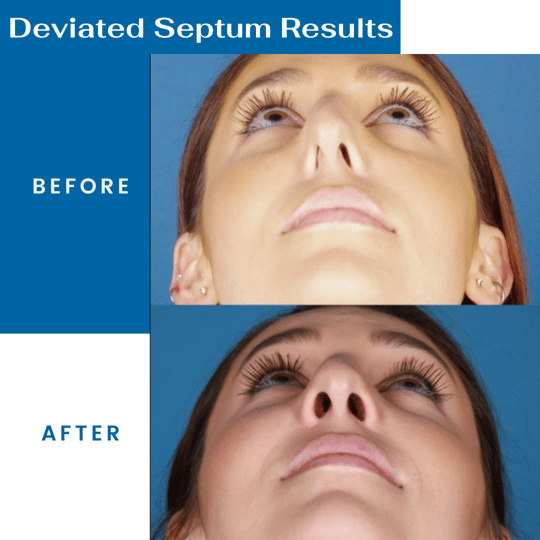 deviated septum before and after