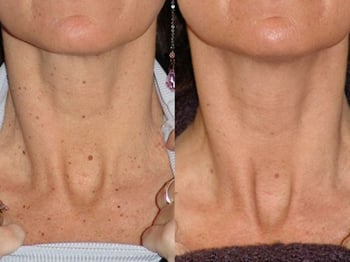 Before and After Diolite Laser