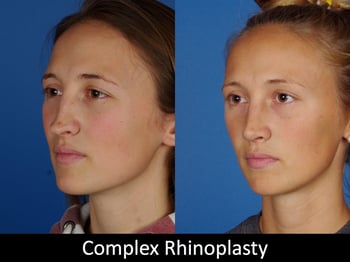 Complex Rhinoplasty