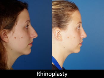 Denver Rhinoplasty 