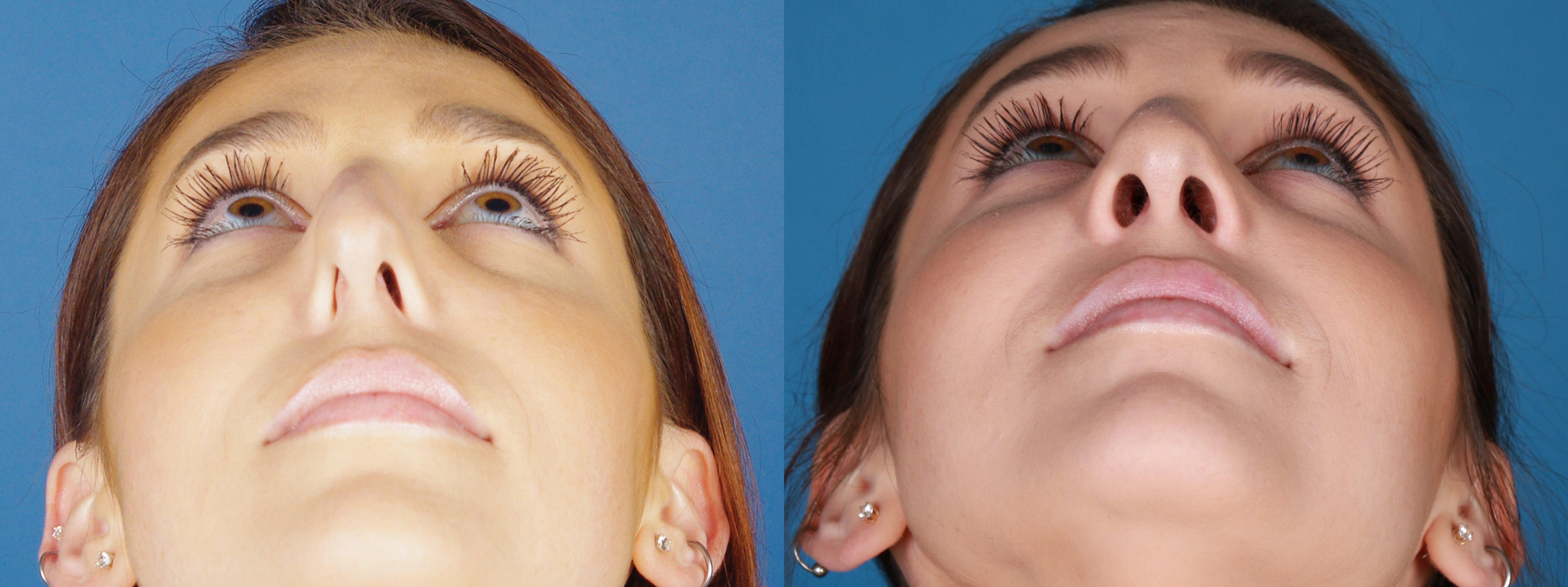 Deviated Septum Before and After