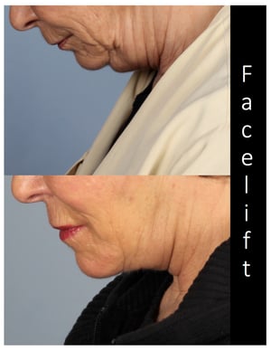 Facelift Surgery