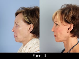 Facelift RavalMD