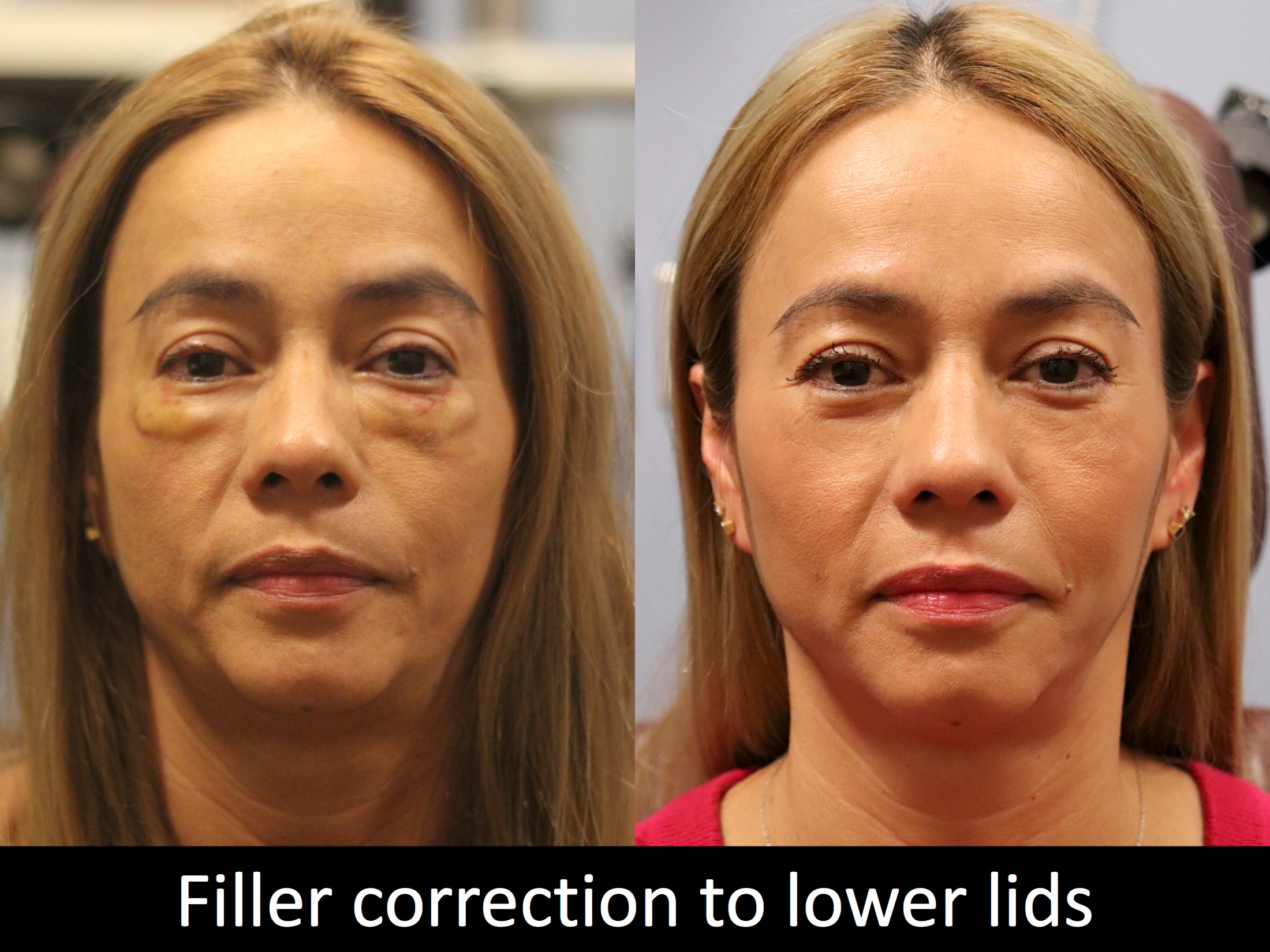 permanent fillers