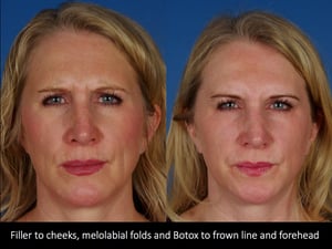 Filler to malars, MLF and botox to frown line and forehead