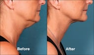 Kybella Skin Tightening Before and AFter