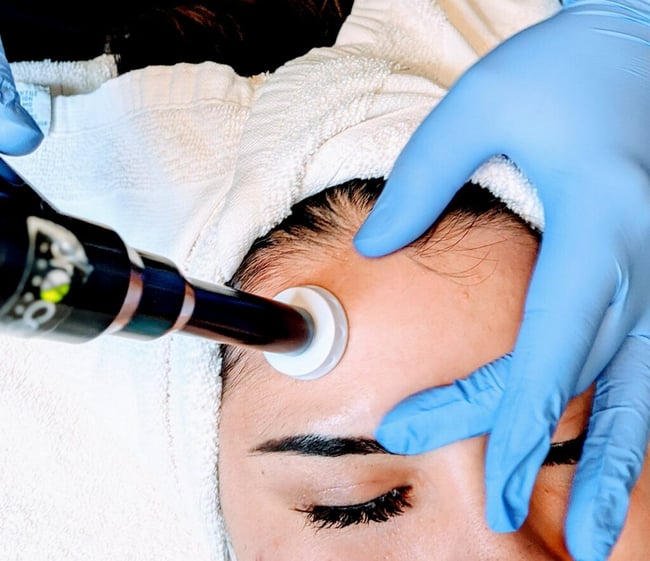 Microneedling