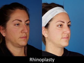 Revision Rhinoplasty