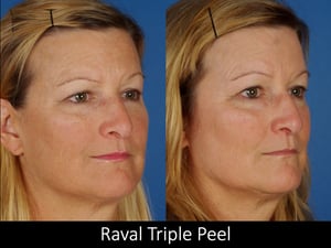 Raval Triple Peel 2 