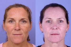 Botox before and afters