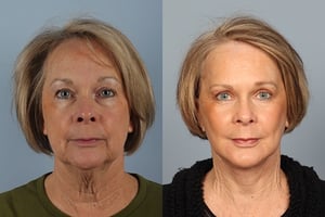Facelift before & after