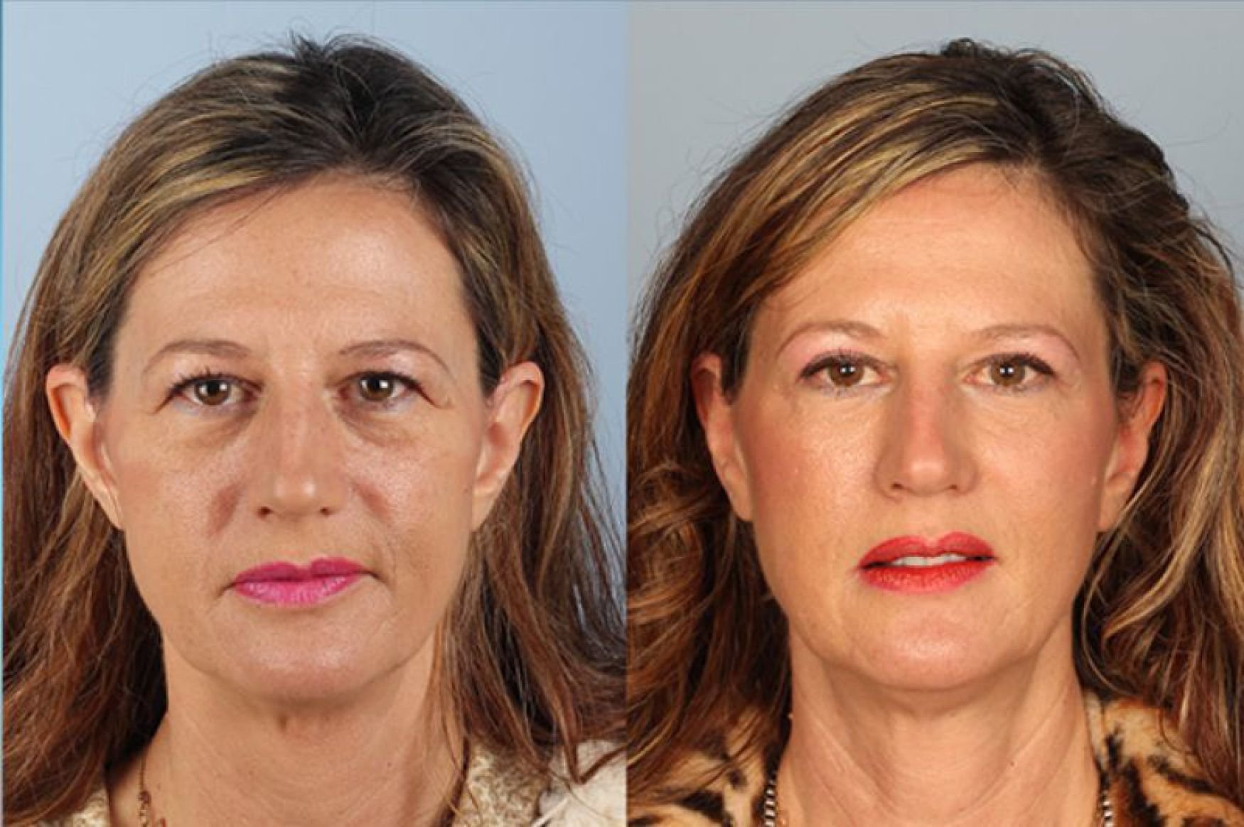 blepharoplasty