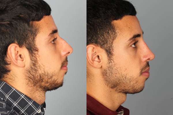 Ethnic Rhinoplasty