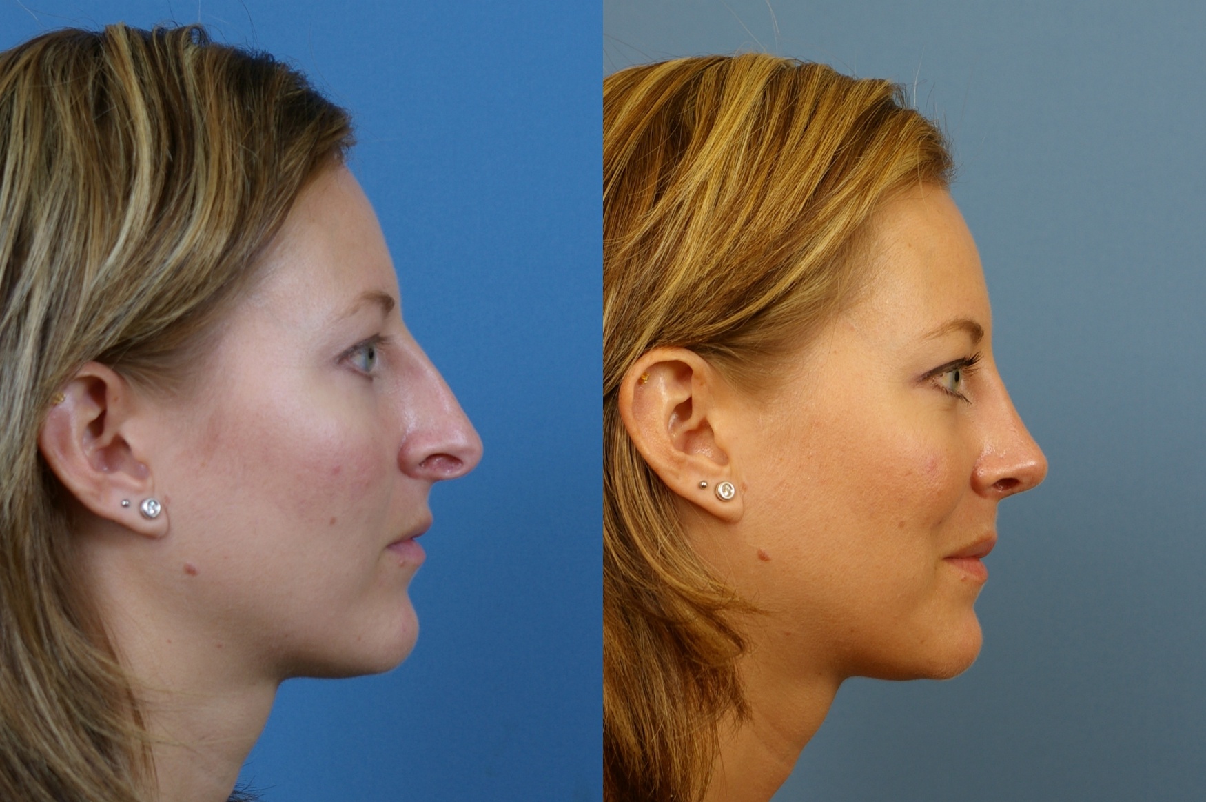 Allison Raskin Nose Job