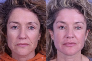 Ravalbotox