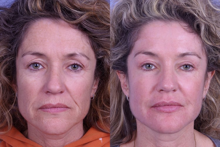 Ravalbotox